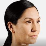 Voluma Before & After Patient #1627