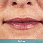Juvederm Volbella Before & After Patient #1609