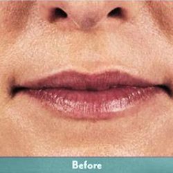 Juvederm Volbella Before & After Patient #1609
