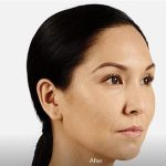 Voluma Before & After Patient #1627