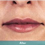 Juvederm Volbella Before & After Patient #1609