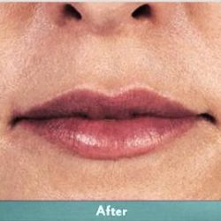 Juvederm Volbella Before & After Patient #1609