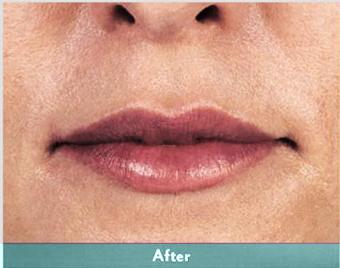 Juvederm Volbella Before & After Patient #1609