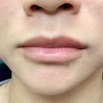 Restylane Kysse Before & After Patient #1615