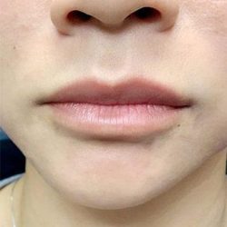 Restylane Kysse Before & After Patient #1615