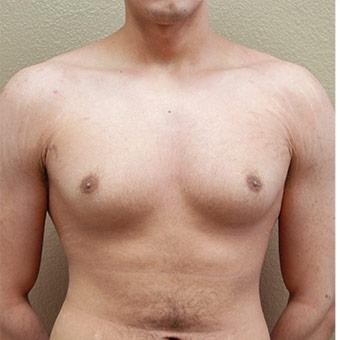 Male Breast Reduction Before & After Patient #1566
