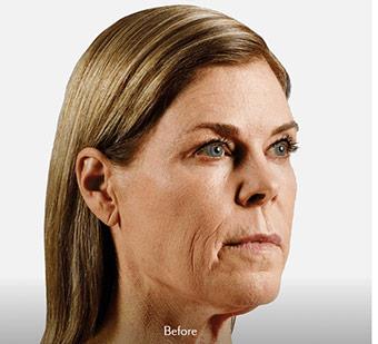 Voluma Before & After Patient #1628