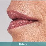 Juvederm Volbella Before & After Patient #1610