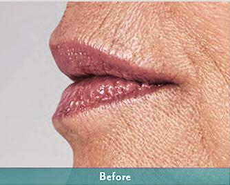 Juvederm Volbella Before & After Patient #1610