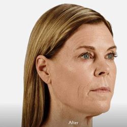 Voluma Before & After Patient #1628