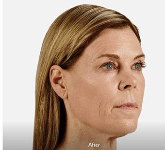 Voluma Before & After Patient #1628