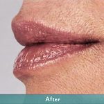 Juvederm Volbella Before & After Patient #1610
