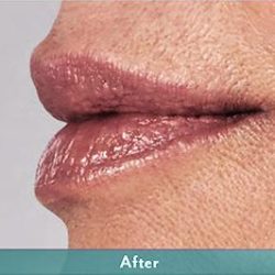 Juvederm Volbella Before & After Patient #1610