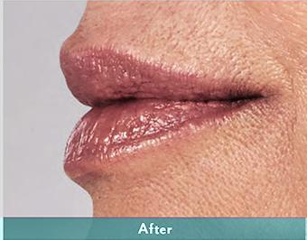 Juvederm Volbella Before & After Patient #1610