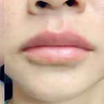 Restylane Kysse Before & After Patient #1615