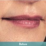 Juvederm Volbella Before & After Patient #1611
