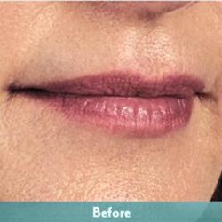 Juvederm Volbella Before & After Patient #1611
