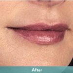 Juvederm Volbella Before & After Patient #1611