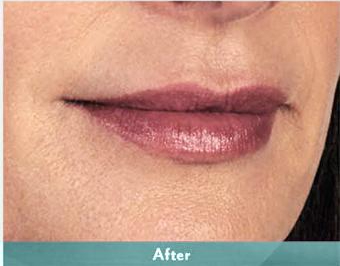 Juvederm Volbella Before & After Patient #1611