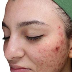 VI Peel Before & After Patient #1533
