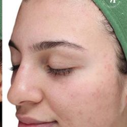 VI Peel Before & After Patient #1533