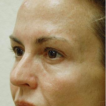 Blepharoplasty Before & After Patient #1352