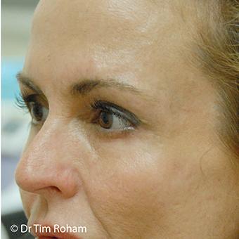 Blepharoplasty Before & After Patient #1352