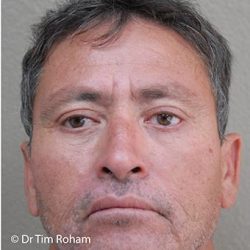 Blepharoplasty Before & After Patient #1354