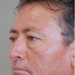 Blepharoplasty Before & After Patient #1354