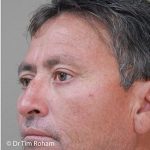 Blepharoplasty Before & After Patient #1354