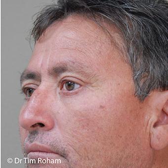 Blepharoplasty Before & After Patient #1354