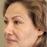 Blepharoplasty Before & After Patient #1355