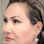 Blepharoplasty Before & After Patient #1355