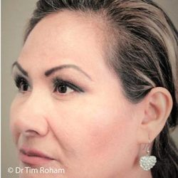 Blepharoplasty Before & After Patient #1355