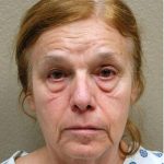 Blepharoplasty Before & After Patient #1357
