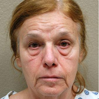 Blepharoplasty Before & After Patient #1357