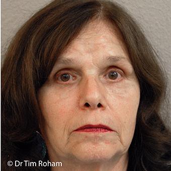 Blepharoplasty Before & After Patient #1357
