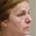 Blepharoplasty Before & After Patient #1357