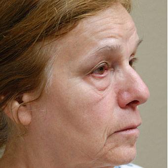 Blepharoplasty Before & After Patient #1357