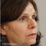 Blepharoplasty Before & After Patient #1357