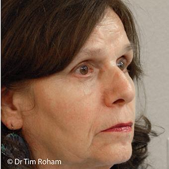 Blepharoplasty Before & After Patient #1357