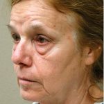 Blepharoplasty Before & After Patient #1357