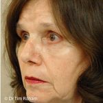 Blepharoplasty Before & After Patient #1357