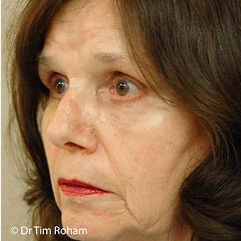 Blepharoplasty Before & After Patient #1357
