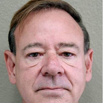 Blepharoplasty Before & After Patient #1358