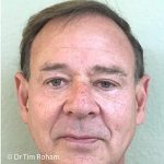 Blepharoplasty Before & After Patient #1358