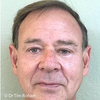 Blepharoplasty Before & After Patient #1358