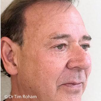 Blepharoplasty Before & After Patient #1358