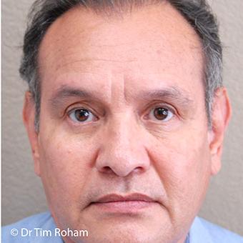 Blepharoplasty Before & After Patient #1360