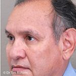 Blepharoplasty Before & After Patient #1360